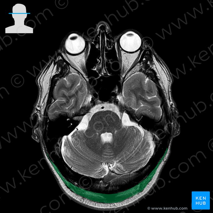 Musculus occipitalis (Hinterhauptsmuskel); Bild: 