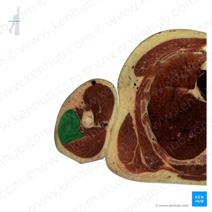 Lateral head of triceps brachii muscle (Caput laterale musculi tricipitis brachii); Image: National Library of Medicine