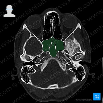 Seno esfenoidal (Sinus sphenoidalis); Imagen: 