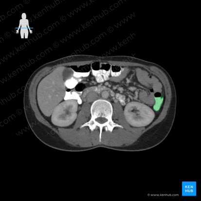 Descending colon (Colon descendens); Image: 
