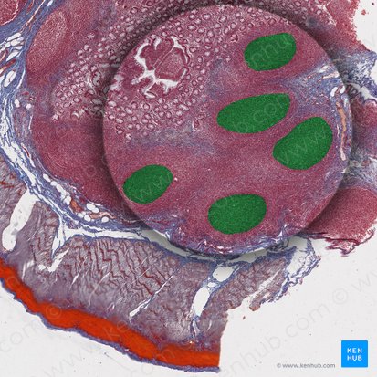 Aggregated lymphoid nodules of ileum (Peyer's patches) (Noduli lymphoidei aggregati ilei); Image: 