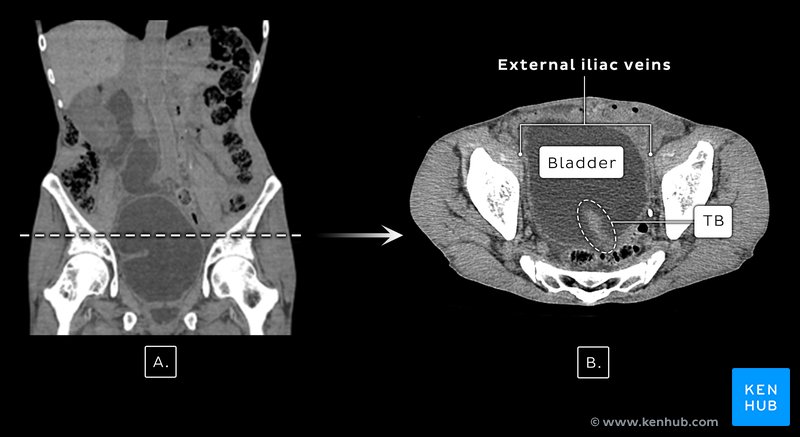 Distended Bladder - Coronal CT