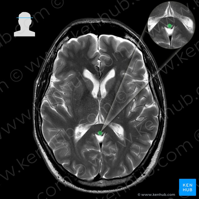 Vena cerebral magna (Vena magna cerebri); Imagen: 