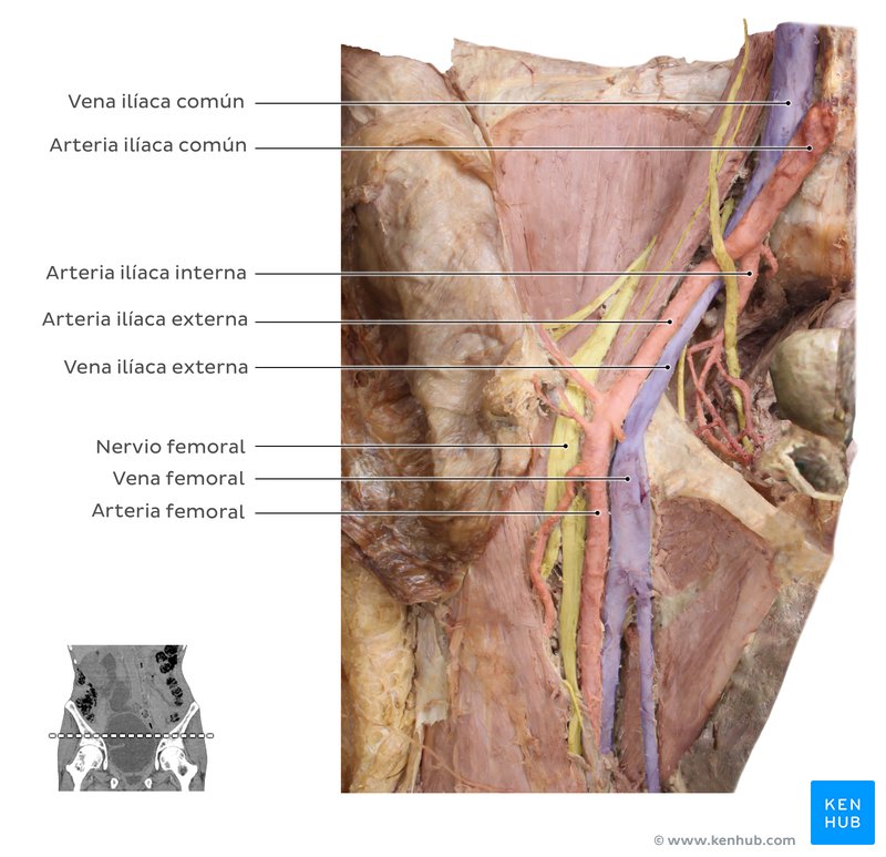 Disección cadavérica de los vasos ilíacos