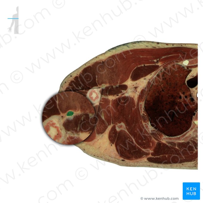 Long head of biceps brachii muscle (Caput longum musculi bicipitis brachii); Image: National Library of Medicine