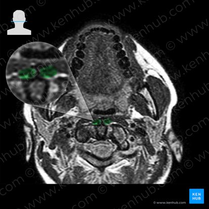 Músculo largo del cuello (Musculus longus colli); Imagen: 