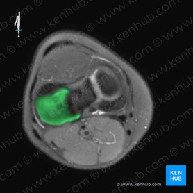 Cóndilo lateral de la tibia (Condylus lateralis tibiae); Imagen: 