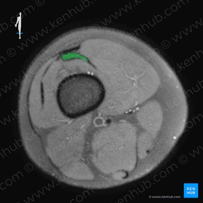 Tendón del músculo vasto intermedio (Tendo musculi vasti intermedii); Imagen: 