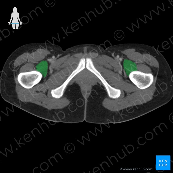 Musculus iliopsoas (Darmbein-Lenden-Muskel); Bild: 