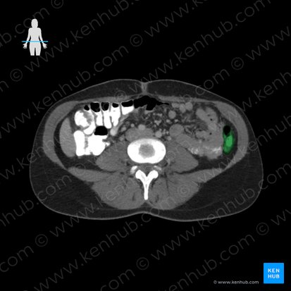 Descending colon (Colon descendens); Image: 