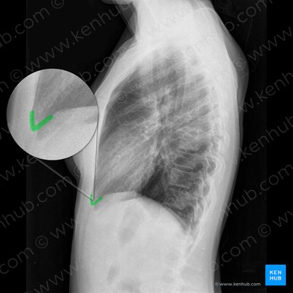 Right anterior costophrenic angle (Angulus costophrenicus anterior dexter); Image: 