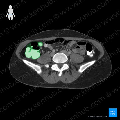 Ascending colon (Colon ascendens); Image: 