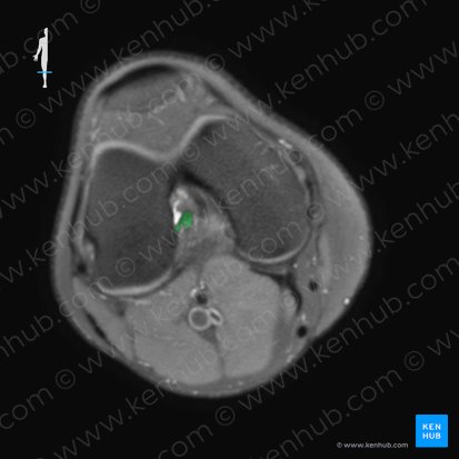 Ligamentum cruciatum anterius (Vorderes Kreuzband); Bild: 