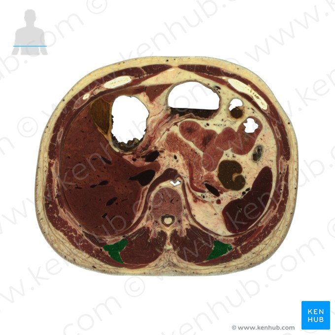 Longissimus muscle (Musculus longissimus); Image: National Library of Medicine