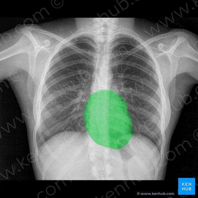 Silueta cardiaca; Imagen: 