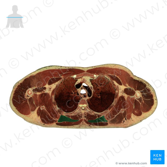Rhomboid major muscle (Musculus rhomboideus major); Image: National Library of Medicine
