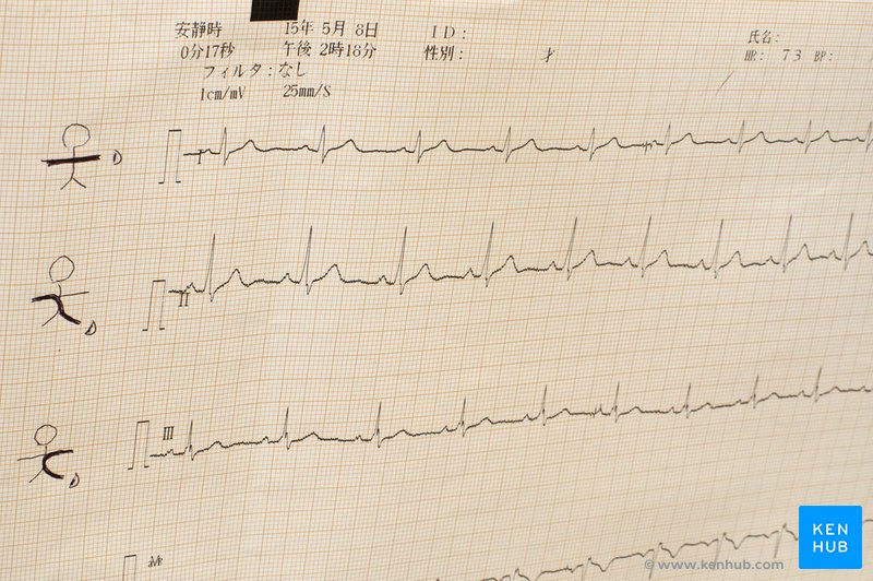 Electrocardiogram