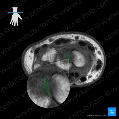 Ligamenta intercarpea interossea (Zwischenknochenbänder der Handwurzelknochen); Bild: 