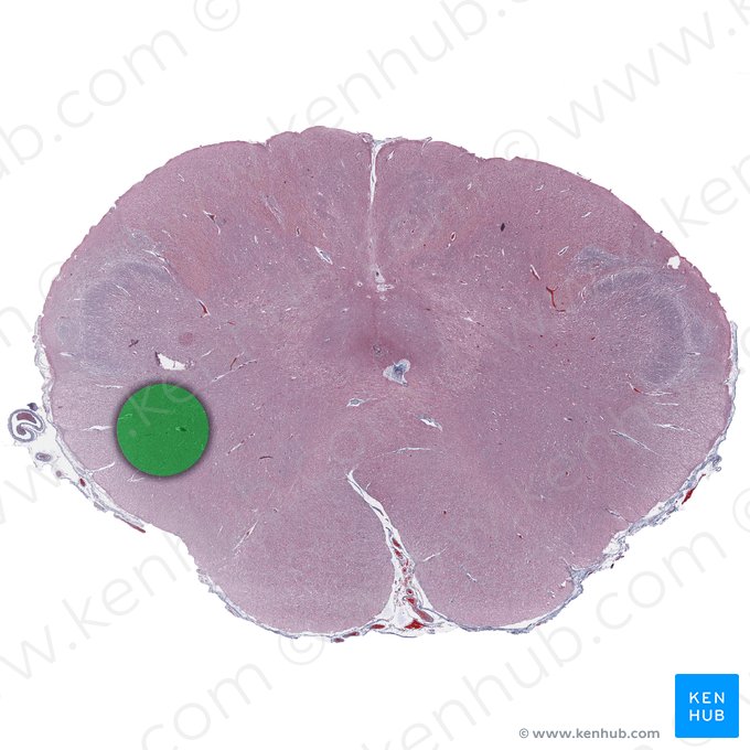 Spinothalamic tract (Tractus spinothalamicus); Image: 