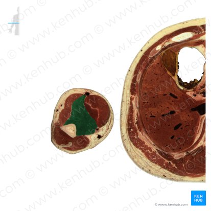 Músculo braquial (Musculus brachialis); Imagen: National Library of Medicine