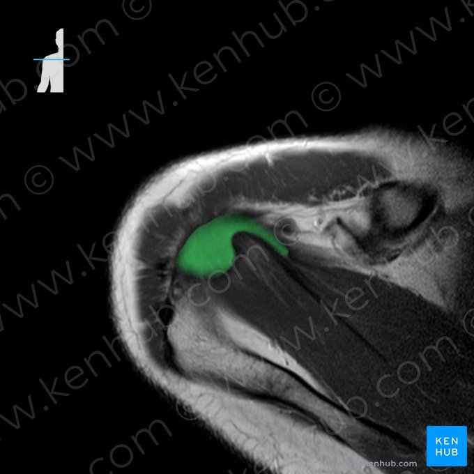 Tendon of supraspinatus muscle (Tendo musculi supraspinati); Image: 