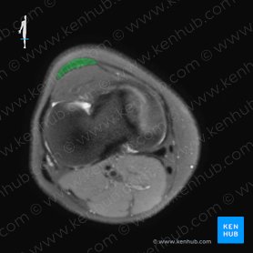 Patellar ligament (Ligamentum patellae); Image: 