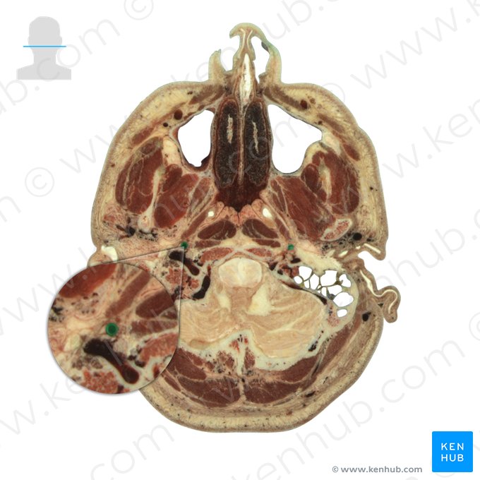 Artéria carótida interna (Arteria carotis interna); Imagem: National Library of Medicine