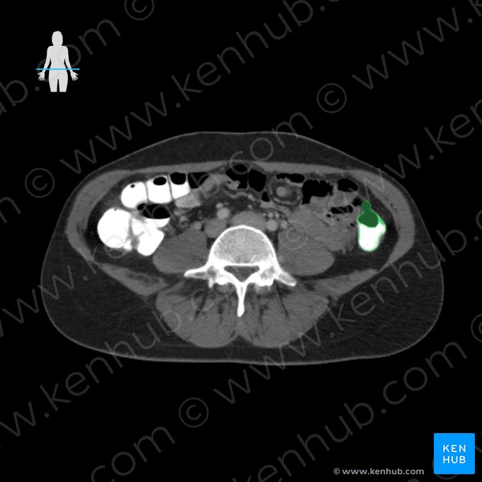 Descending colon (Colon descendens); Image: 