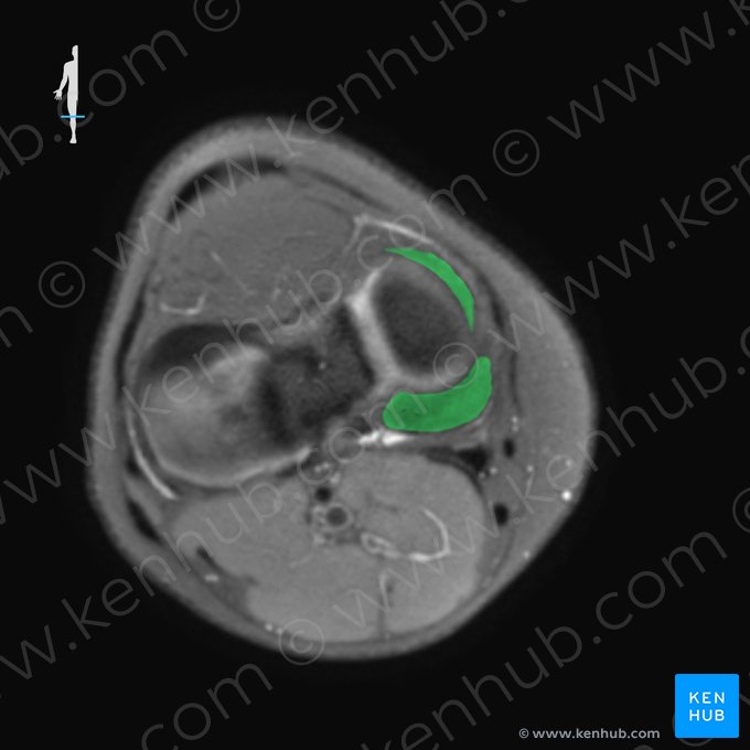 Menisco medial (Meniscus medialis); Imagen: 