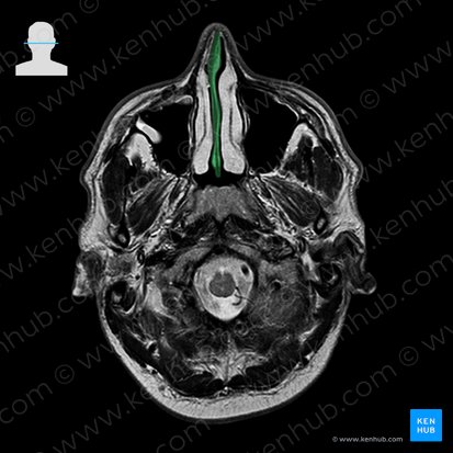 Septo nasal (Septum nasi); Imagem: 