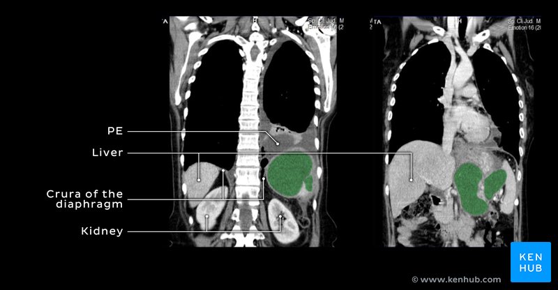 Pseudocysts and pleural effusion