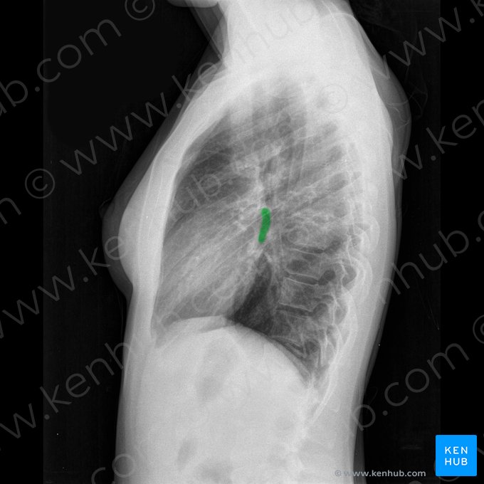 Bronquio principal izquierdo (Bronchus principalis sinister); Imagen: 