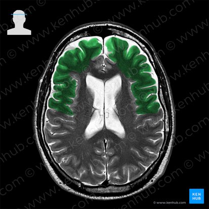 Lobus frontalis (Stirnlappen); Bild: 