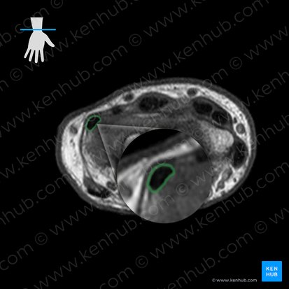 Vagina tendinis musculi extensoris carpi ulnaris (Sehnenscheide des ellenseitigen Handstreckers); Bild: 