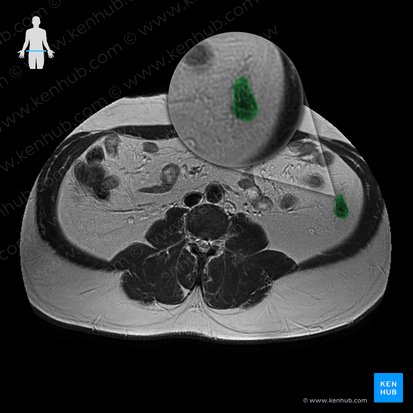 Descending colon (Colon descendens); Image: 