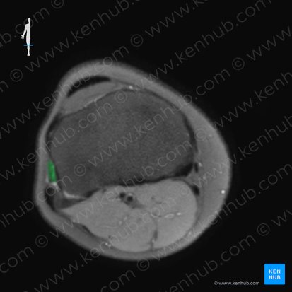 Musculus fibularis longus (Langer Wadenbeinmuskel); Bild: 