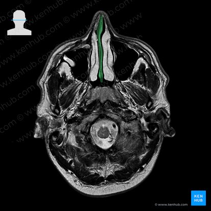 Nasal septum (Septum nasi); Image: 