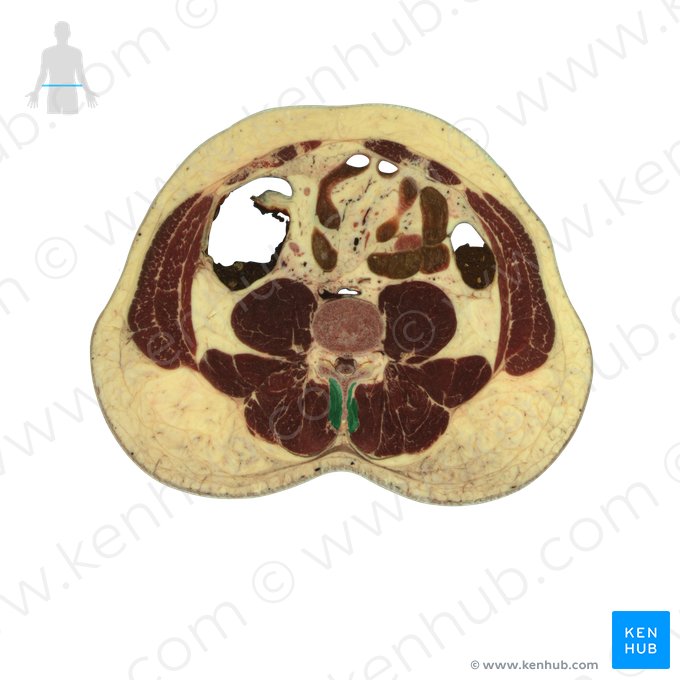 Musculi interspinales (Zwischendornmuskeln); Bild: National Library of Medicine