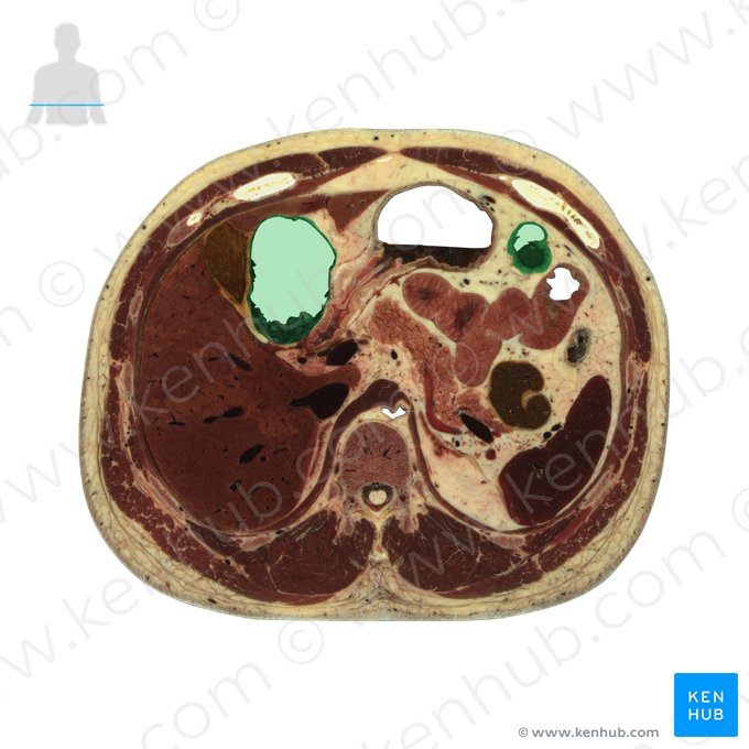 Colon transversum (Querverlaufender Dickdarm); Bild: National Library of Medicine