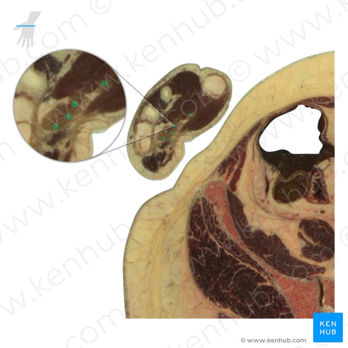 Tendons of flexor digitorum profundus muscle (Tendines musculi flexoris digitorum profundus); Image: National Library of Medicine