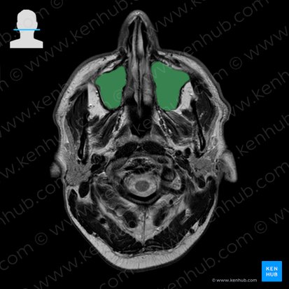 Seio maxilar (Sinus maxillaris); Imagem: 