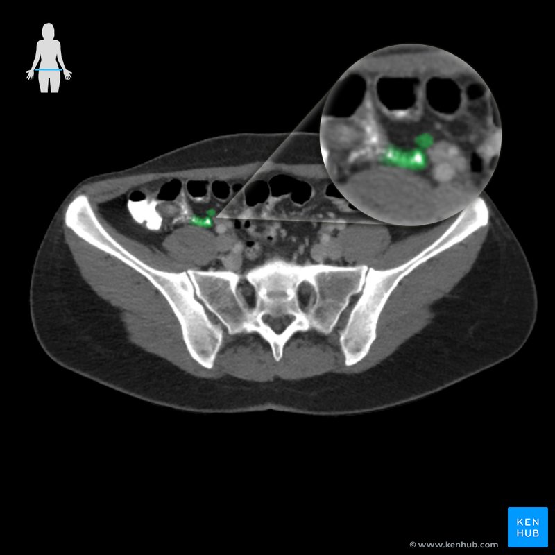 Apêndice vermiforme - vista axial 