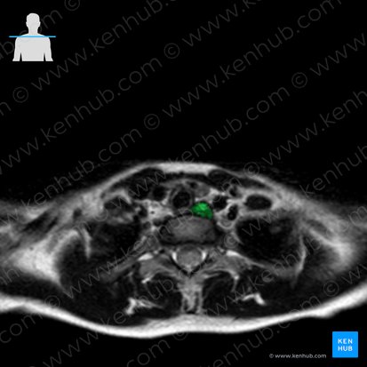 Pars cervicalis oesophagi (Halsteil der Speiseröhre); Bild: 