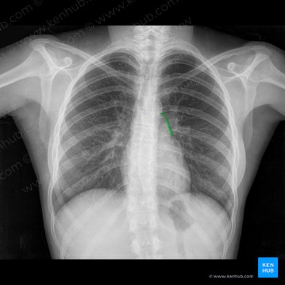 Borda do tronco pulmonar (Margo trunci pulmonalis); Imagem: 
