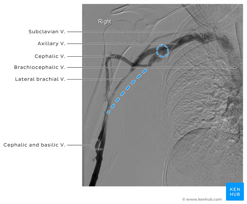 Venous obstruction of the axillary vein - venographic image