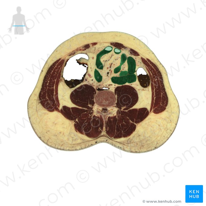 Íleo (Ileum); Imagem: National Library of Medicine