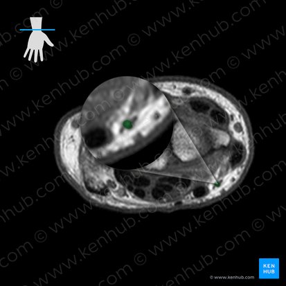 Superficial palmar branch of radial artery (Ramus palmaris superficialis arteriae radialis); Image: 