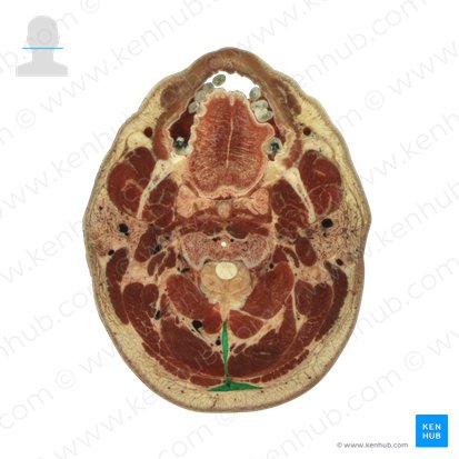 Ligamentum nuchae (Nackenband); Bild: National Library of Medicine