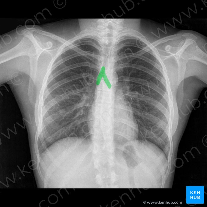 Tracheal bifurcation (Bifurcatio tracheae); Image: 