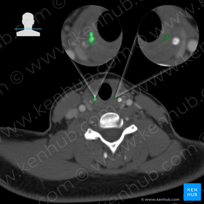 Cricoid cartilage (Cartilago cricoidea); Image: 